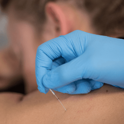 dry needling